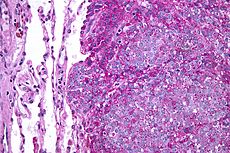 Ewings Sarcoma Under Microscope