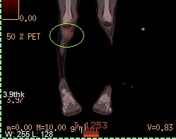 Ewings Sarcoma PET Scan Imagery